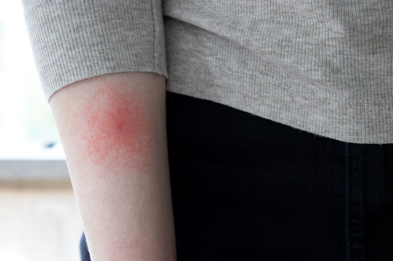 Lyme Disease Rash